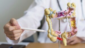 Cambios en la dieta reducen el riesgo de cáncer de colon