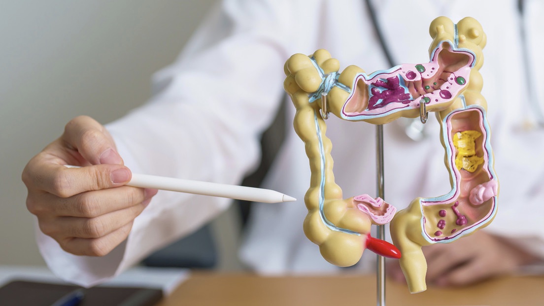 Cambios en la dieta reducen el riesgo de cáncer de colon