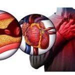 Detener un ataque al corazón y un accidente cerebrovascular
